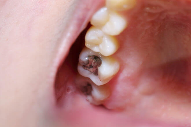 Tobacco Chewing Effects To Your Teeth Tidatabase